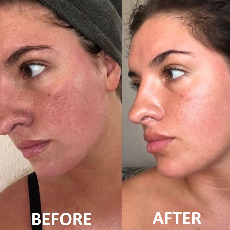 Professional 7-Color LED Face Mask - Clear Skin in 7 Days