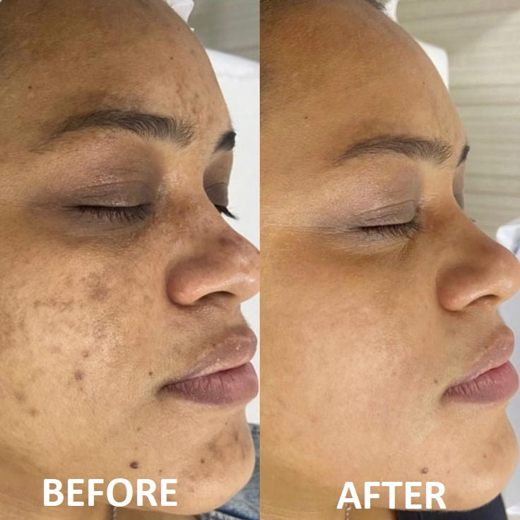 Professional 7-Color LED Face Mask - Clear Skin in 7 Days